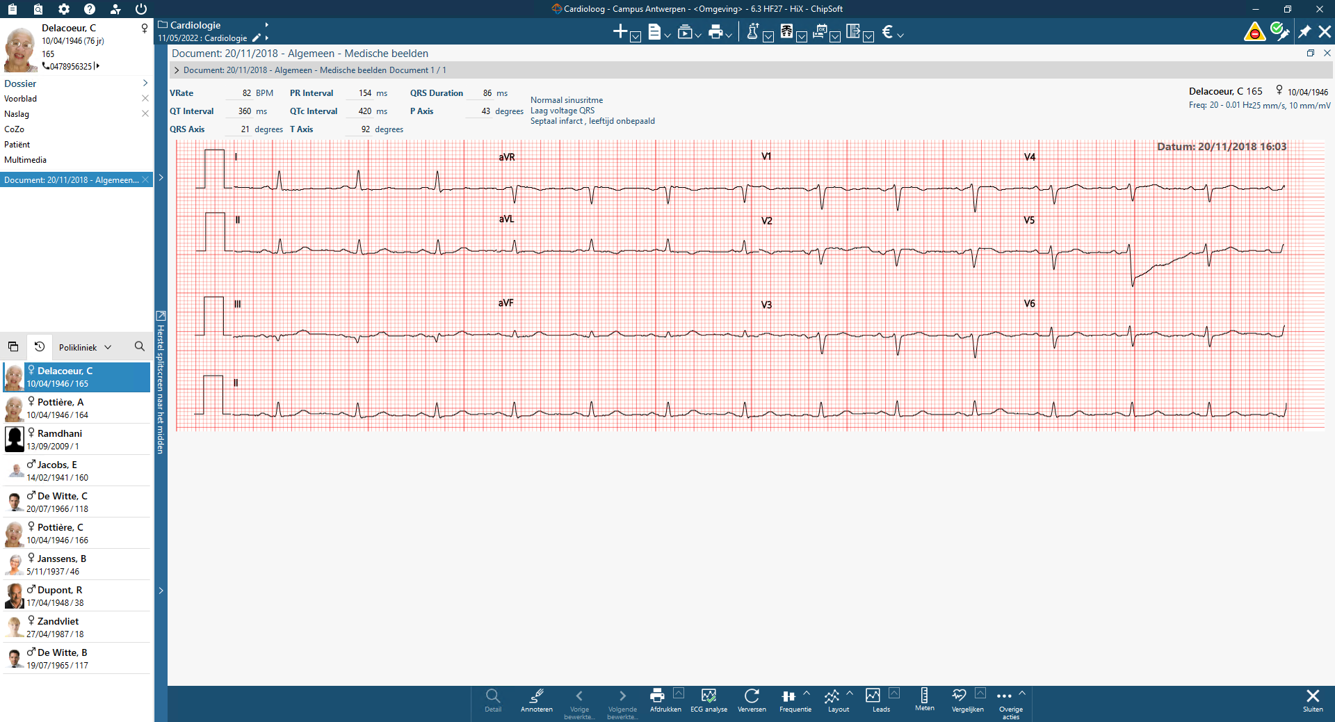 ECG ECG